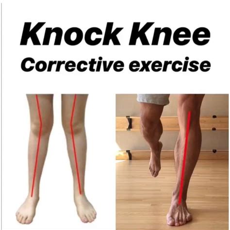 Knock Knees Exercises Knee Exercises Gym Workouts Workout Plan At