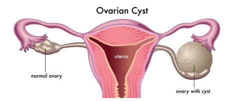 What is a complex cyst on the ovary? Ovarian Cyst: Symptoms, Causes and Treament - Hoool Health ...