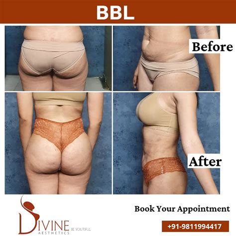 Bbl Before After The Brazilian Buttock Augmentation Is A P Flickr