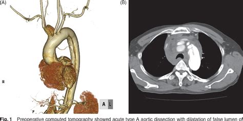 Figure 1 From A Case Of Dissection And Rupture Of The Innominate Artery
