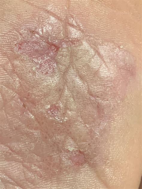 Painful Dyshidrotic Eczemablistering On Sole Of Foot Tips For