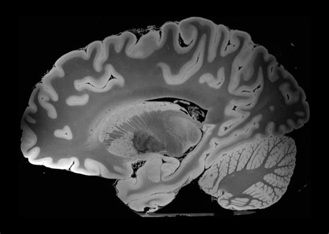 The Highest Resolution MRI Scan Of A Human Brain Mri Scan Mri Human Brain