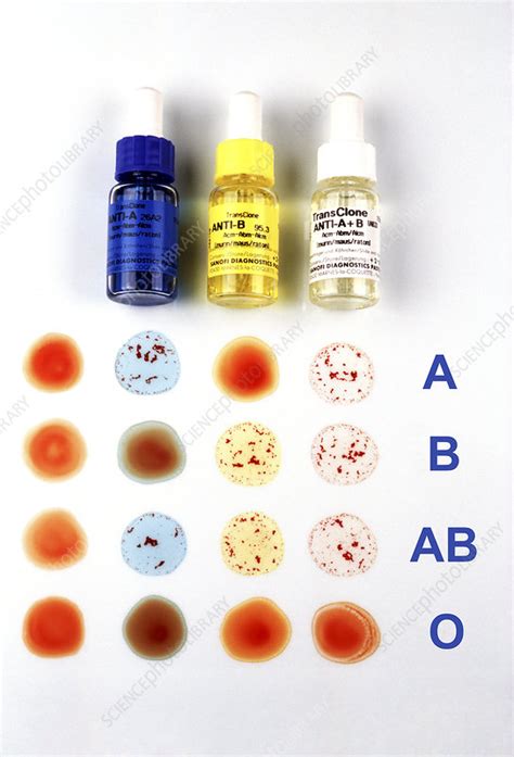 Receiving blood from the wrong abo pregnant women are always given a blood group test. Blood group test - Stock Image - M530/0654 - Science Photo ...