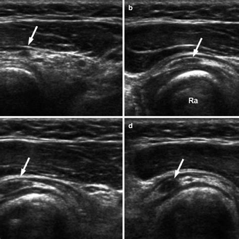 1 Series Of Transverse Ultrasound Images Showing Posterior Interosseous