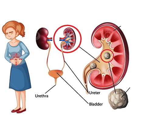 Informative Illustration Of Kidney Stones Science Cartoon Calculus