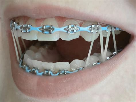 Orthodontics Australia  Elastics For Braces: Rubber Bands in