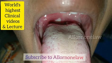 Severe Diphtheria Infection Of The Tonsil White Patch On Tonsil