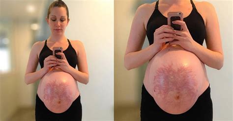 Marked Why We Need To Carry Our Pregnancy Stretch Marks With Pride