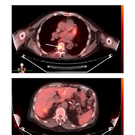 Pdf Utility Of Petct In The Staging And Treatment Of Patients With