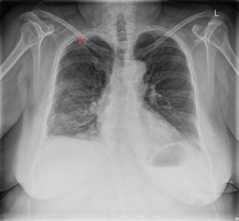 Chest X Ray Showing Recurrent Pneumothorax On The Right Side Red Arrow