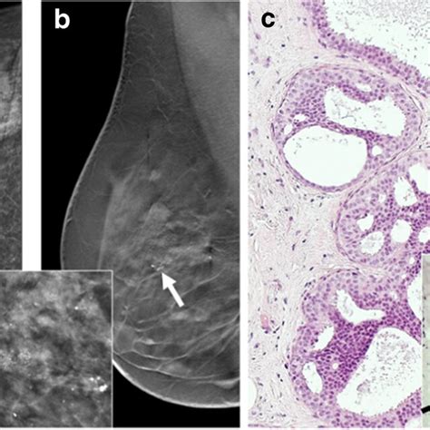 Radial Scarcomplex Sclerosing Lesion Rscsl A Mammogram