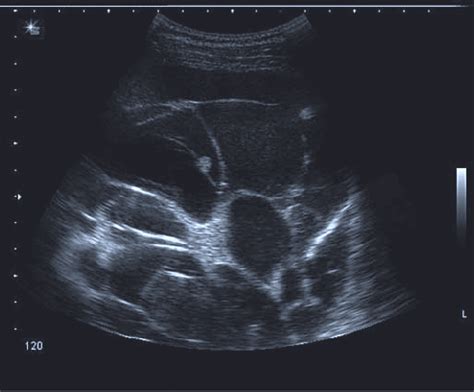 Obliteration of left costophrenic angle with a wide pleural based dome shaped opacity projecting into. Ultrasound image of multiple septations and loculations in ...