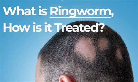 What Is Ringworm How Is It Treated Quartz Hair