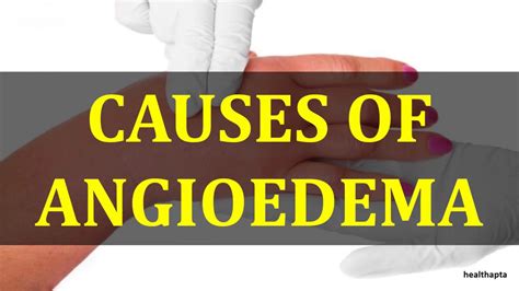 Causes Of Angioedema Youtube