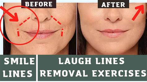 Nasolabial Folds Laugh Lines Removal Exercises Face Yoga And Face