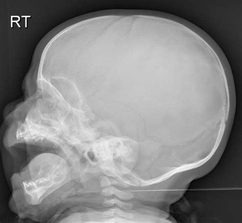 Normal Lateral Skull Child Buyxraysonline