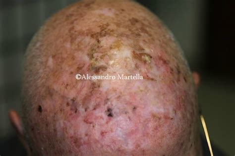 La Cheratosi Attinica E Il Campo Di Cancerizzazione Myskin