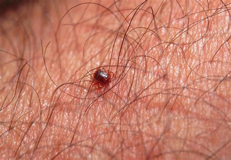 Tick Feeding On Human Skin Photograph By Sinclair Stammersscience