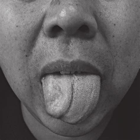 The Patients Tongue Deviates Toward The Right During Tongue