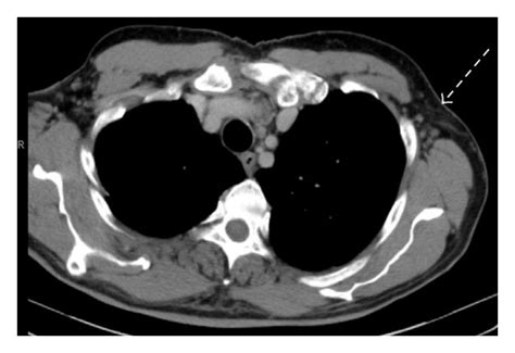 A Pretherapy Enlarged Left Supraclavicular Lymph Node B