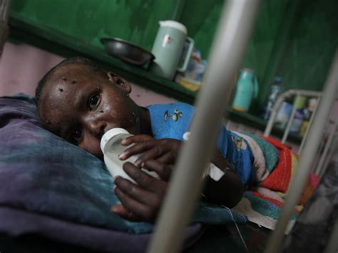 Saúde Em Foco A Desnutrição Na Somália Uma Questão De Saúde Pública