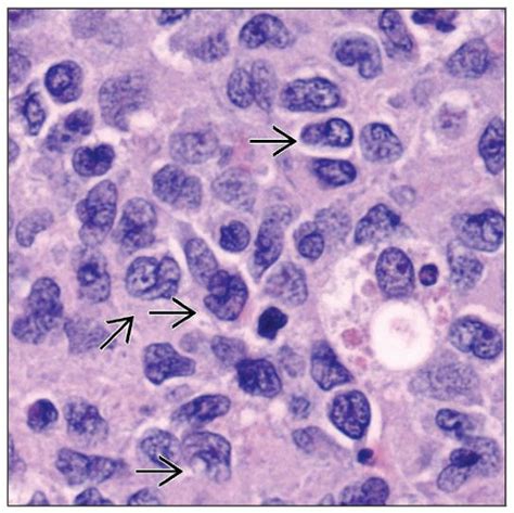 Diffuse Large B Cell Lymphoma Nos Centroblastic Basicmedical Key