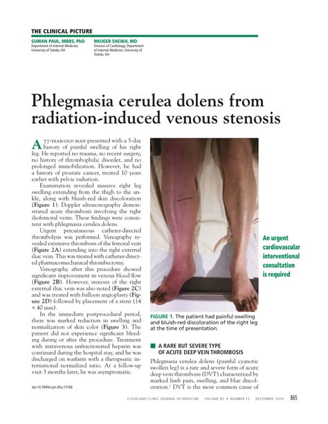 Pdf Phlegmasia Cerulea Dolens From Radiation Induced Venous Stenosis