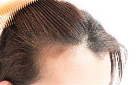 Чудаки и прочие незнакомцы в гта 5. Diradamento dei capelli: cause e 10 rimedi naturali ...