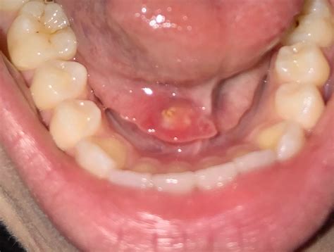 Bc Oral Pathology Case No 46 When Lemonheads Wont Work Dentistryiq