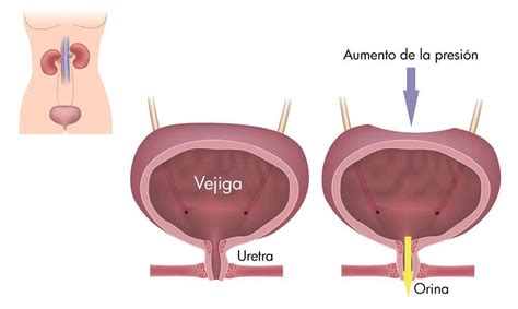 Incontinencia Urinaria Urología Oncológica