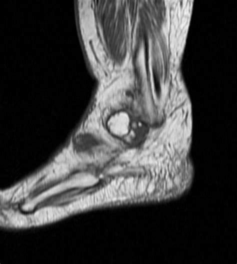 On Radiology Lipoma Arborescens Of Ankle Mri What`s That
