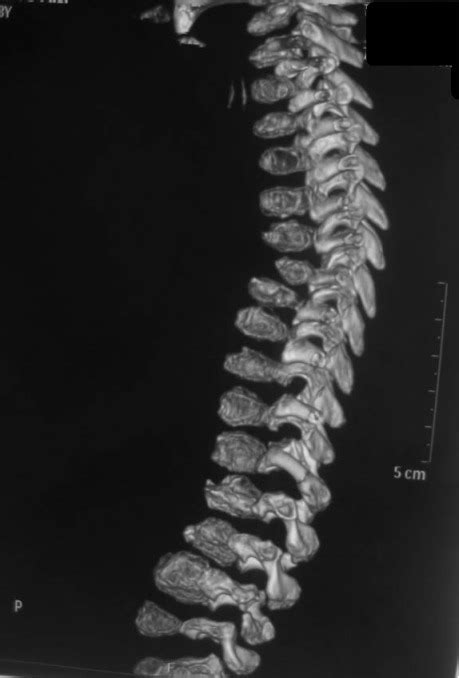 Reformatted Coronal Spinal Ct Scan Showed Significant P Open I