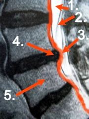 Wir erklären ihnen die mrt funktionsweise sowie die dauer, den ablauf und mögliche nebenwirkungen der mrt untersuchung bei unserer radiologie in berlin. Hexenschuss Ursache