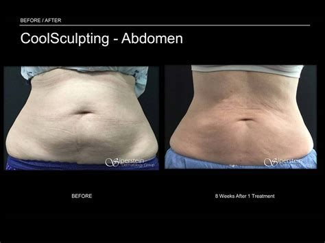 Before And After Photos Of Coolsculpting Treatment Results