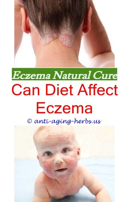 Face Treatment Eczema Doctor Heck