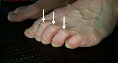 What Causes Lumps Between Toes Damian Moore Kapsels