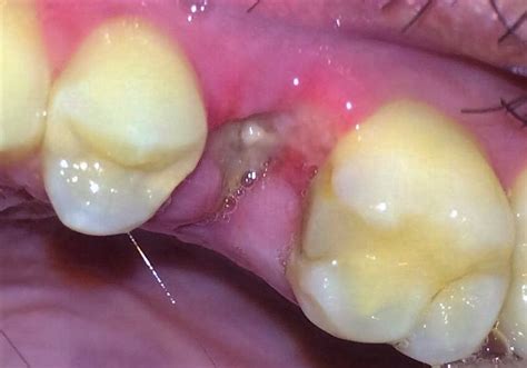 Normal Socket After Tooth Extraction