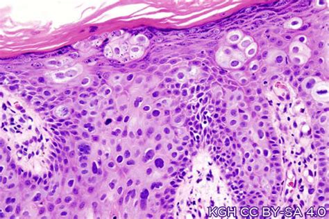 Tumor Budding In Cutaneous Squamous Cell Carcinoma Is A High Risk