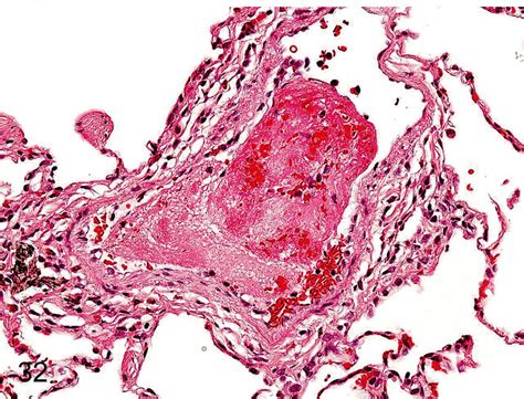 Lung Thrombus Thrombus Occasionally Occurs In The Pulmonary Vessels Download Scientific