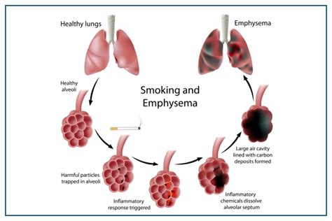 Emphysema Causes Symptoms Complication Treatment