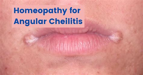 Homeopathy For Cracks In Corner Of Mouth Angular Cheilitis