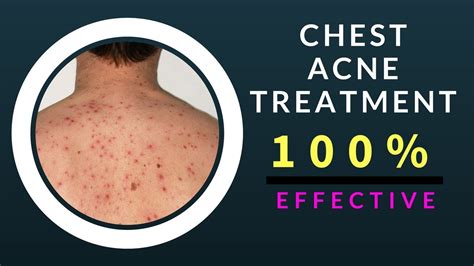 Chest Acne Treatment In Just 7 Days 100 Effective Home Remedy