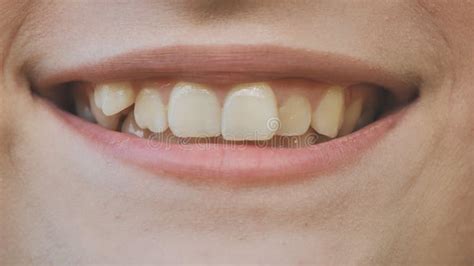A Young Girl Smiles And Shows Her Crooked Teeth Stock Image Image Of