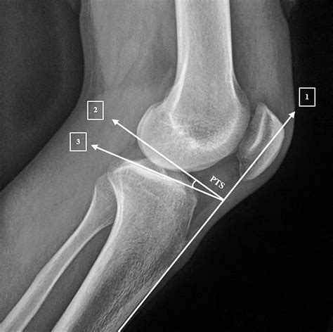 Cureus Variability Of The Posterior Tibial Slope In Saudis A
