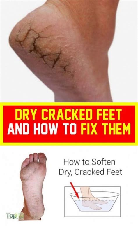 Dry Cracked Feet And How To Correct Them Dry Cracked Feet Cracked