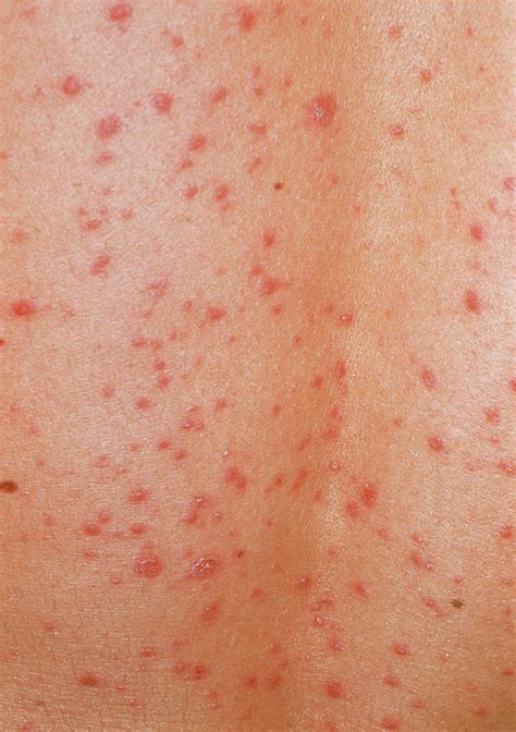 Guttate Psoriasis Skin Rash Photograph By Cnriscience Photo Library