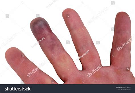 2 Paroxysmal Finger Hematoma 이미지 스톡 사진 및 벡터 Shutterstock