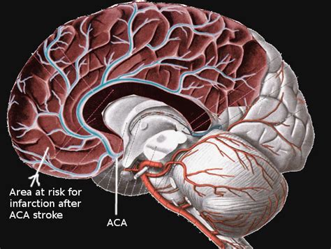 Figure Anterior Cerebral Artery Stroke Image Courtesy S Bhimji Md