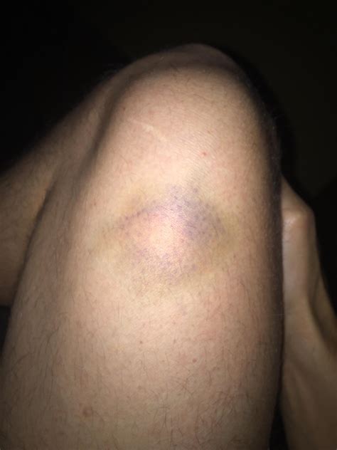 Circular bruise with hard white center? It is not painful except when I