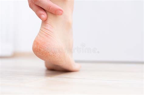 The Dry Skin On The Heel Is Cracked Treatment Concept With